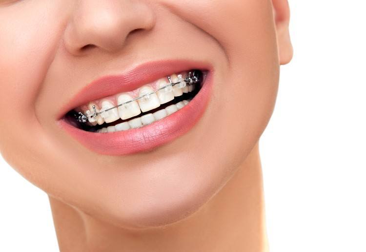 انواع و أضرار عمليات تقويم الاسنان