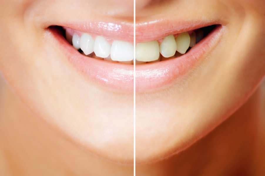 فوائد تبييض الاسنان بالليزر واضراره