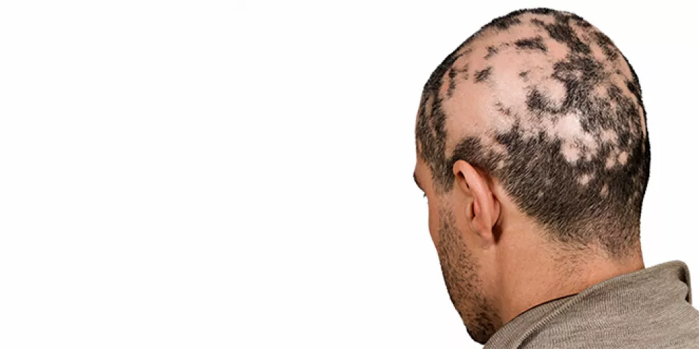 كيف نتعامل مع الثعلبة البقعية ؟