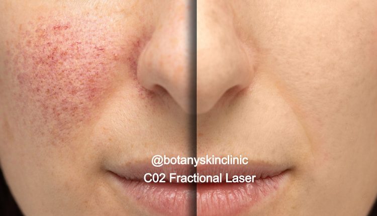 Fractional carbon dioxide laser.