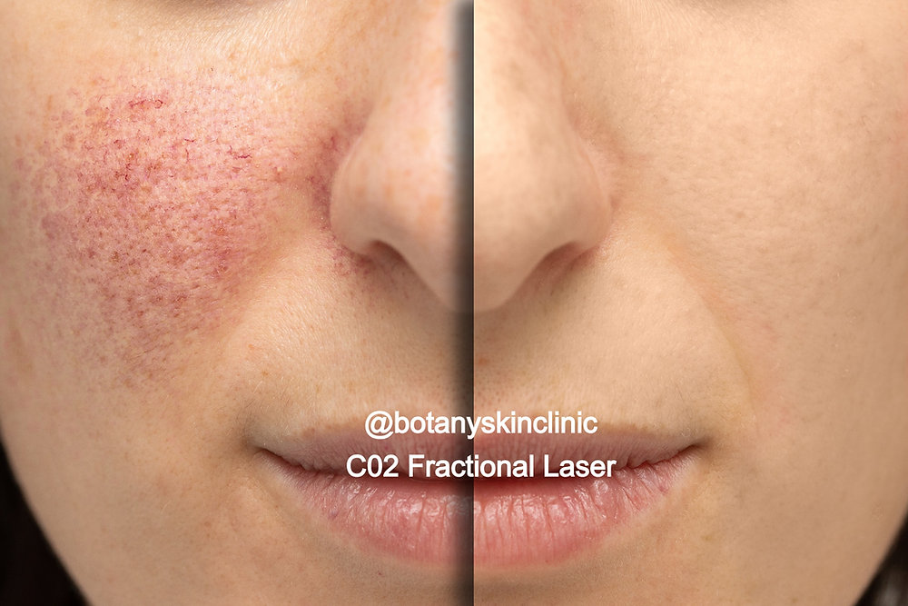 Fractional carbon dioxide laser.