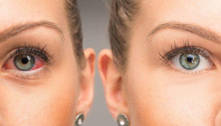Glaucoma