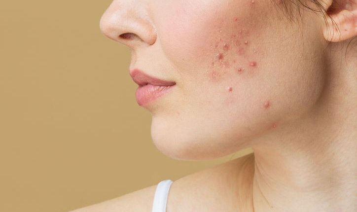 acne-prone skin