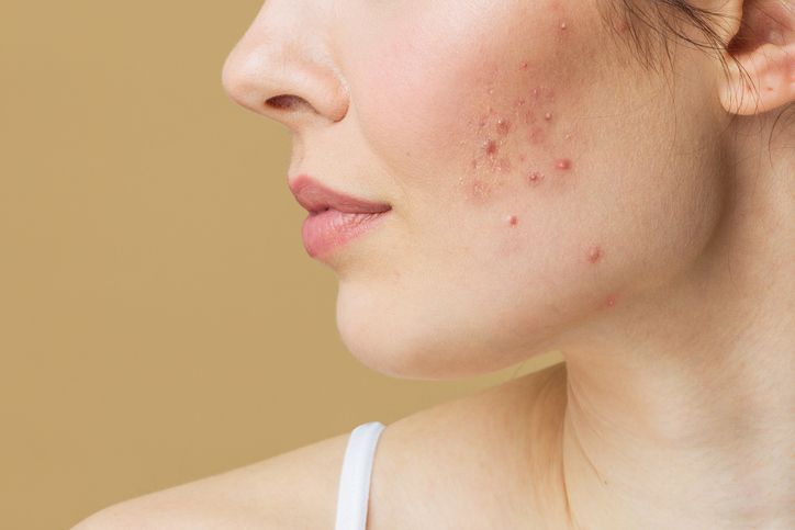 acne-prone skin