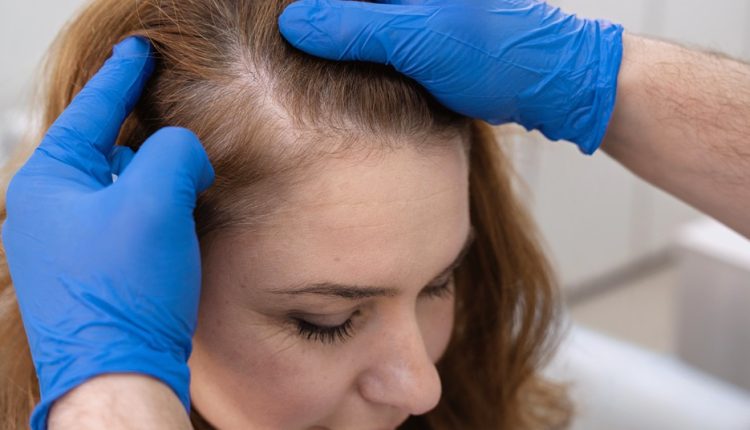 زراعة الشعر